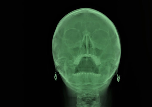x ray of the paranasal sinuses of the skull, medical diagnosis