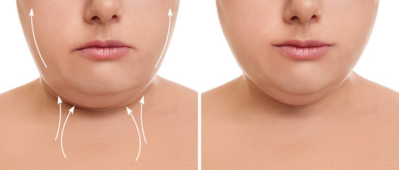 Woman before and after plastic surgery operation on white background, closeup. Double chin problem