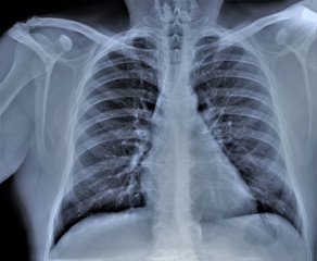 chest x-ray, pneumonia, emphysema, pulmonology, diagnosis of diseases