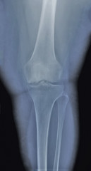 x ray of the knee joint , medical diagnostics, traumatology and orthopedics