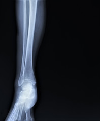 normal radiograph of the ankle joint in front projection