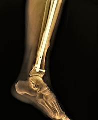 the x-rays of intramedullary osteosynthesis in the fracture of the tibia,implant