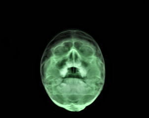 x ray of the paranasal sinuses of the skull, medical diagnosis