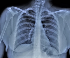 chest x-ray, pneumonia, emphysema, pulmonology, diagnosis of diseases