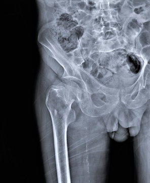  x-ray of hip joint with femoral neck fracture, traumatology and orthopedics