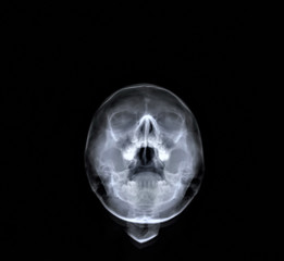 Fototapeta na wymiar x ray of the paranasal sinuses of the skull, medical diagnosis