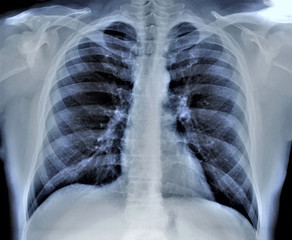 chest x-ray, pneumonia, emphysema, pulmonology, diagnosis of diseases
