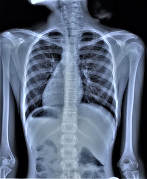 chest x-ray, pneumonia, emphysema, pulmonology, diagnosis of diseases