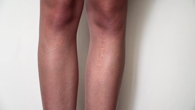 The scar on the leg. Bone fracture or tumor removal. Recovery