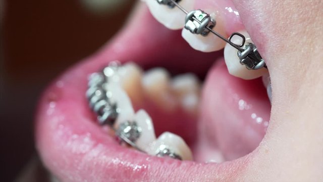 Extreme close view of patient's teeth with new braces. Orthodontist is fixing the arch wire