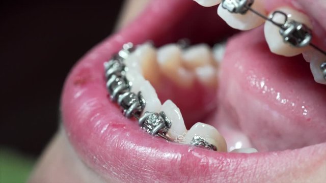 Extreme close view of patient's teeth with new braces. Orthodontist is fixing the arch wire with dental equipment
