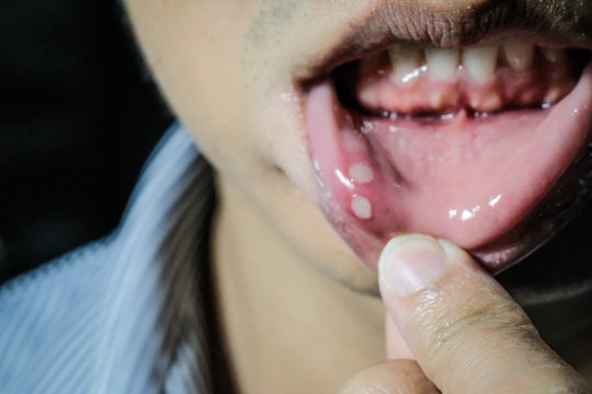 Mouth ulcers - Close up of Asian man with aphtha on lip, with copy space for text. pain from accident.