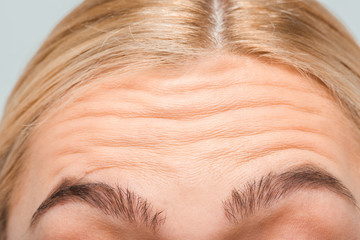 close up of forehead with wrinkles of woman