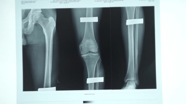 x-ray with bone fracture on a computer monitor