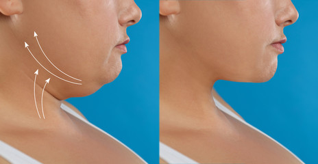 Woman before and after plastic surgery operation on blue background, closeup. Double chin problem - obrazy, fototapety, plakaty