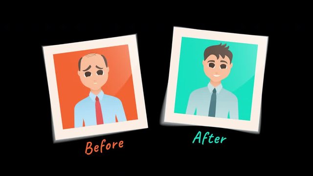 Man before and after hair transplantation treatment. Cartoon animation of two pictures. Male hair loss motion design graphics with alpha channel. Beauty medical transformation concept. 