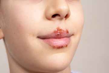 Obraz premium Closeup of a child's face showing an extended area with cold sores