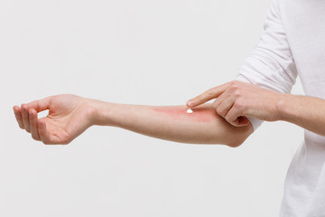 Allergic reaction, itch, dermatitis, dry skin. Man is applying cream/ointment on the swell skin...