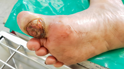 wound on foot diabetic patient, sterile technique, infection control and dressing process,...