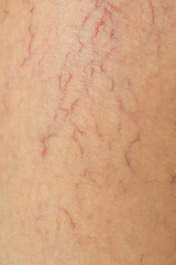 The texture of the background, varicose veins on human skin.