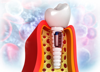 Human dental tooth implant. 3d illustration © Rasi
