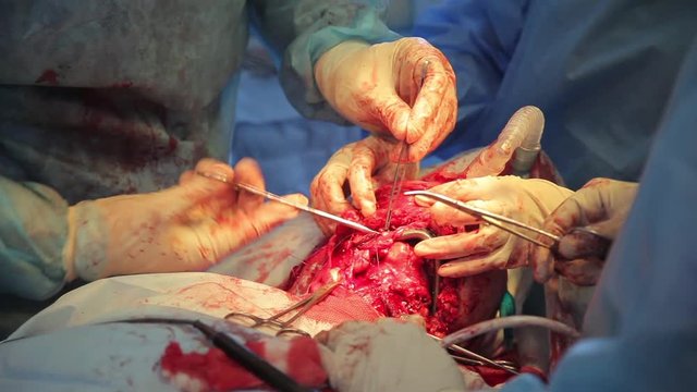 Maxillo-facial operation. Surgeons implant titanium jaw to the patient. Close-up of surgeon`s hands operating patient`s jaw. Close-up of assistant`s hands during surgery. Surgeon stitches patient.