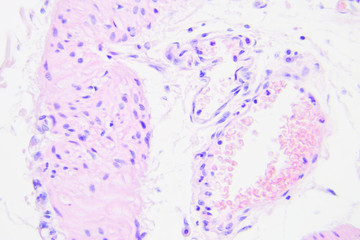 Colon cancer microscopic photography, magnification x400