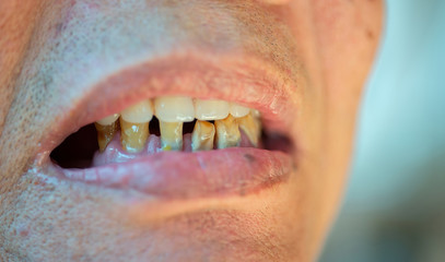 Old and worn-out elderly teeth