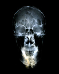 Head x-ray film images used to diagnose neurological and tumor diseases for diagnosis. X-ray film images taken from the x-ray room for diagnosis of faults that require surgery for medical treatment.