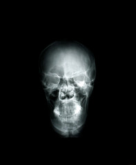 Head x-ray film images used to diagnose neurological and tumor diseases for diagnosis. X-ray film images taken from the x-ray room for diagnosis of faults that require surgery for medical treatment.