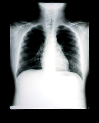 Chest x-ray film photos And the respiratory system for diagnosis in the treatment of diseases X-ray film images taken from the x-ray room for diagnosis of faults that require surgery for medical
