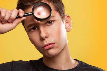 Cosmetology, Dermatology and acne. A sad teenage boy in a black t-shirt, holding a magnifying glass to his face, showing the pimples on his face. Yellow background. Close up
