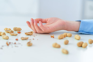 Person having an allergic reaction to peanuts. Intolerable foods and food allergies
