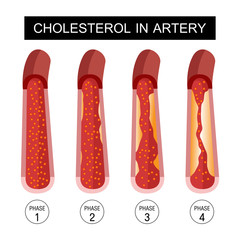 Cholesterol in artery, health risk , vector design