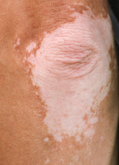 Fototapeta premium White spots on the hand