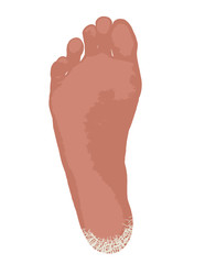 Fototapeta premium 乾燥でひび割れたかかと