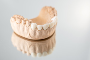 Fototapeta na wymiar Close-up on plaster model of artificial jaw with veneers on the mirror background. Concept of aesthetic dentistry and design of veneers
