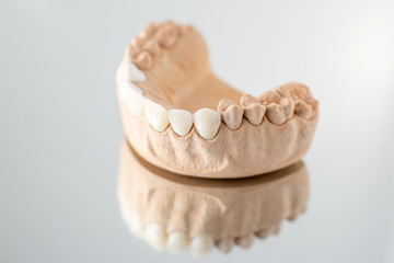 Close-up on plaster model of artificial jaw with veneers on the mirror background. Concept of aesthetic dentistry and design of veneers