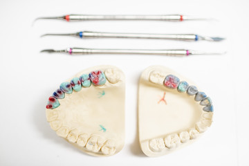 Plaster models of artificial jaw with painted dental prosthesis on the white background. Concept of...