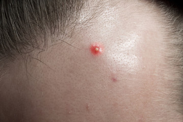 Fototapeta premium pimple on the forehead close-up, acne