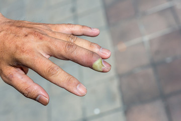 Paronychia, swollen finger with fingernail bed inflammation due to bacterial infection on a...