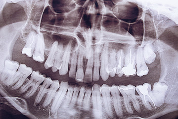 Close-up panoramic shot of the jaw. Dentistry and dental treatment.