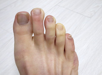 Raynaud's disease