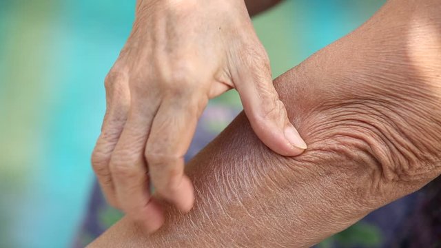 Senior Woman's right hand scratching her left arm, Dry skin on arm, Bokeh blue swimming background, Close up shot, Asian Body skin part, Healthcare concept