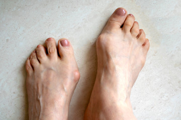 Hallux valgus, big abnormal feet bones.  Bunion on big toes of female feet isolated on light background