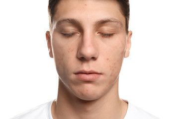 Obraz premium Teen guy with acne problem on white background, closeup
