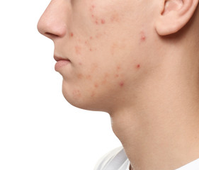 Obraz premium Teen guy with acne problem on white background, closeup