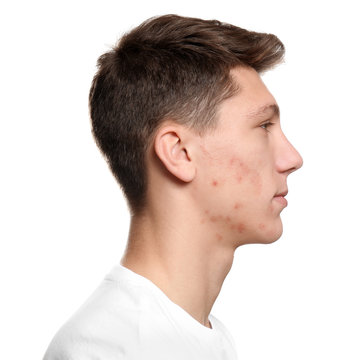 Teen guy with acne problem on white background