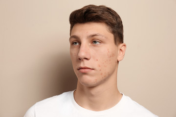 Obraz premium Teen guy with acne problem on beige background