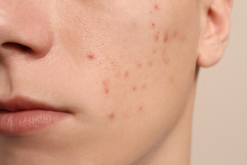 Teen guy with acne problem on beige background, closeup